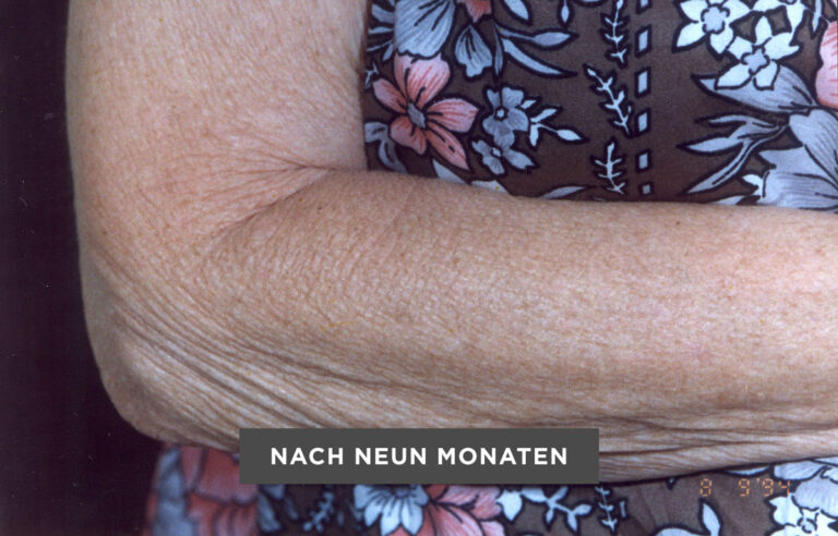 ENVIRON Bild Haut Unterarm nach neun Monaten